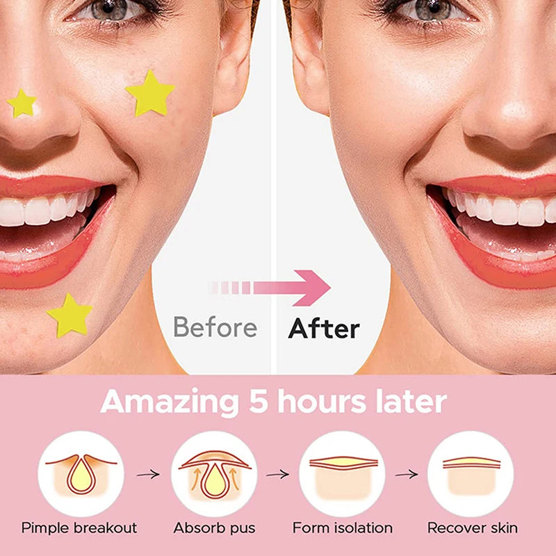 112 PCS/SET Pimple Patch Acne Colorful