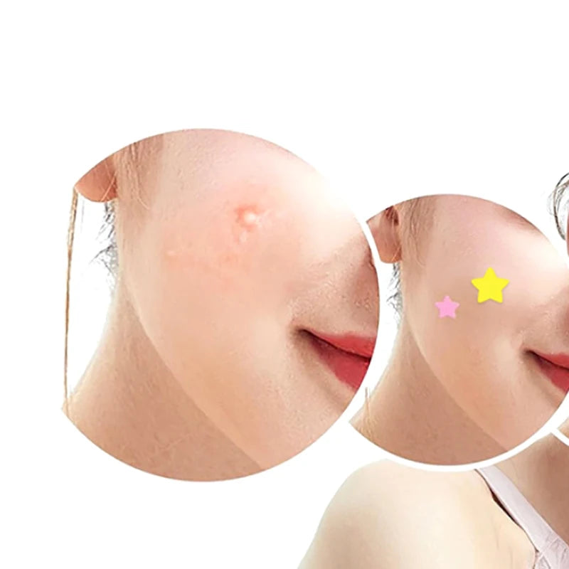 51PCS Acne Patch Facial Skin Care