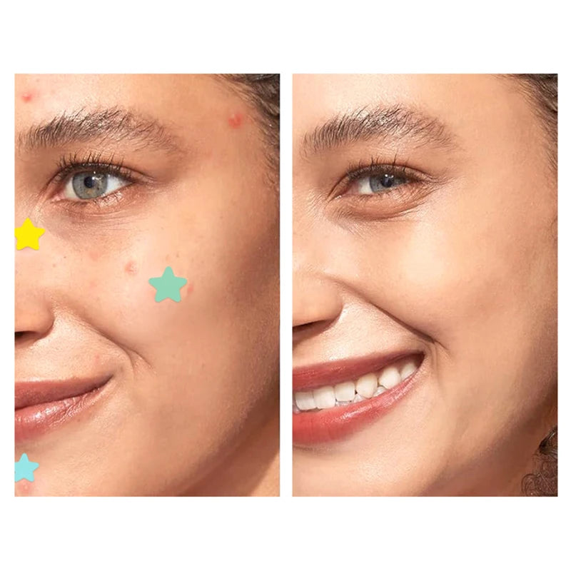 51PCS Acne Patch Facial Skin Care